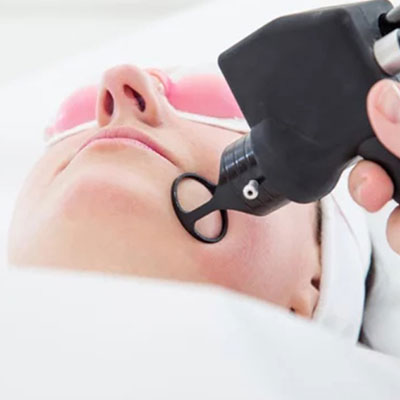 CO2 LASER TREATMENT
