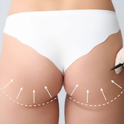 LIFTING DE GLUTEOS CON ACIDO POLILACTICO