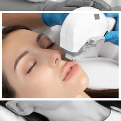 LUZ PULSADA INTENSA – IPL FACIAL