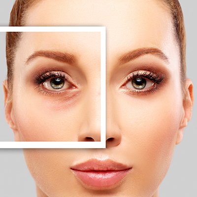 BLEFAROPLASTIA